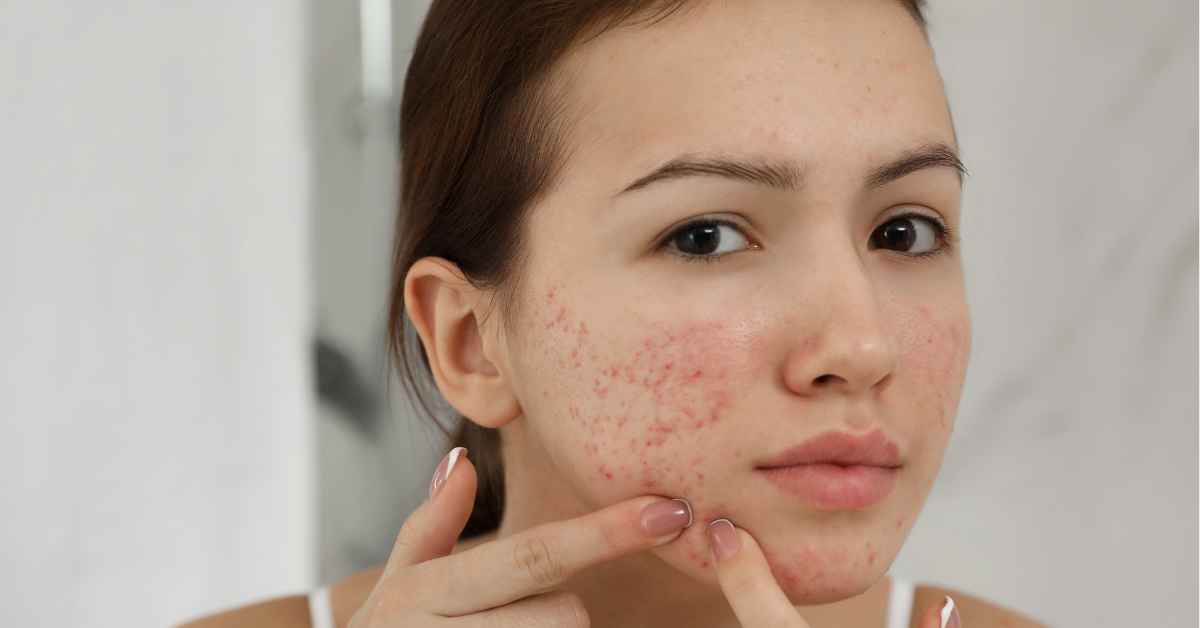 Acne and Acne Scar Treatment in Multan