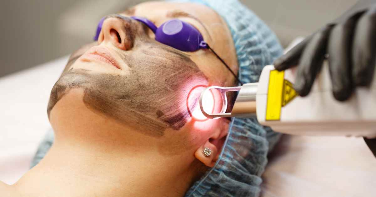 Carbon Laser Peel Treatment in Multan