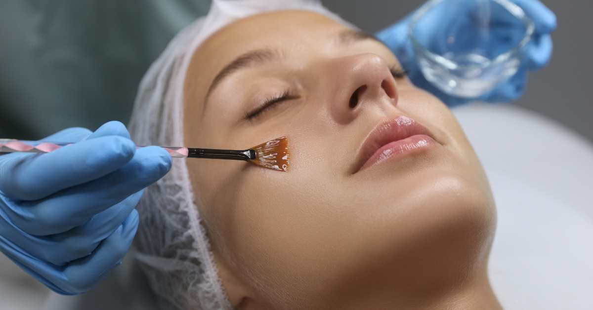 Chemical Skin Peel Treatment in Multan