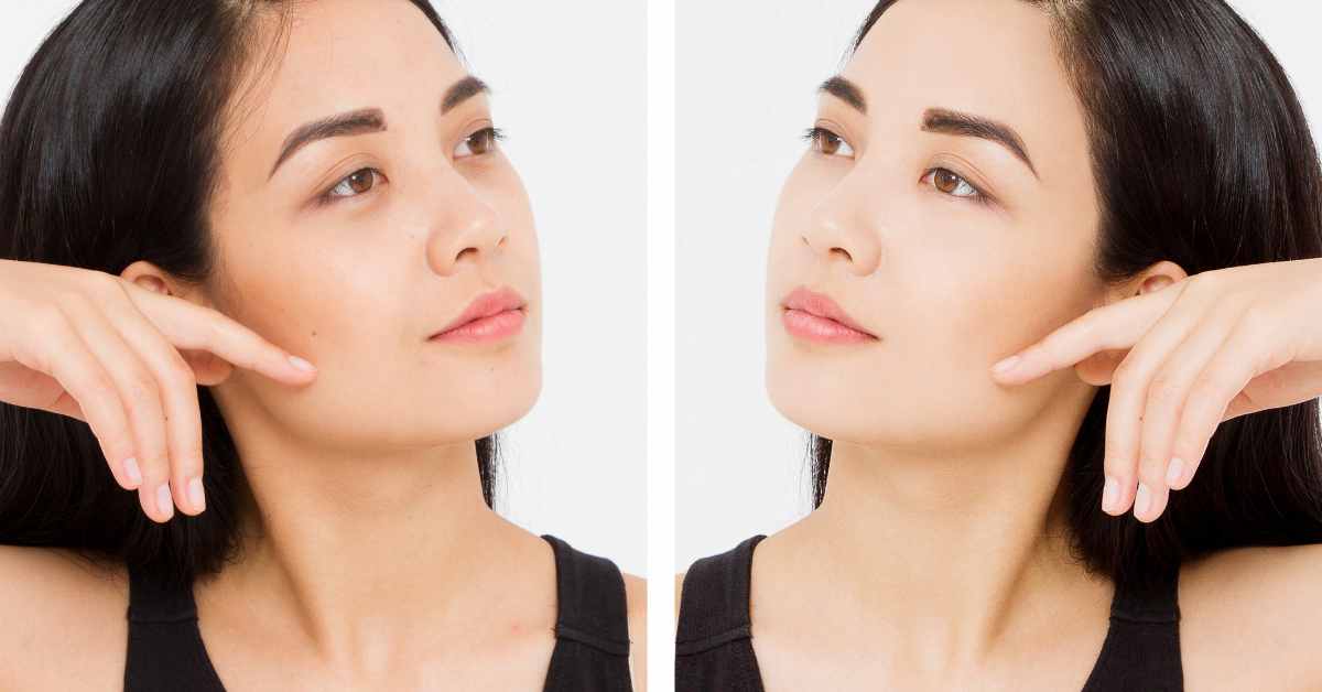 Dark Circles Treatment in Multan