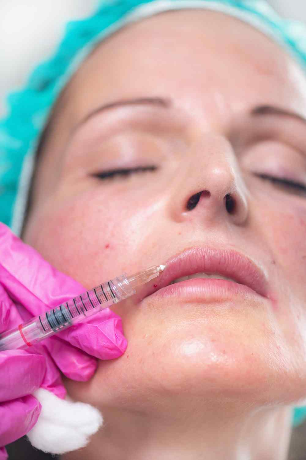 Lip Fillers Treatment