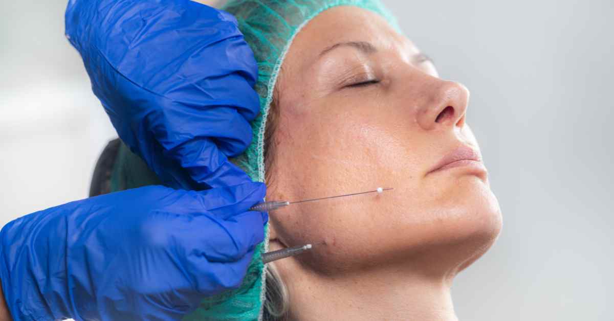Thread Lift Treatment in Multan