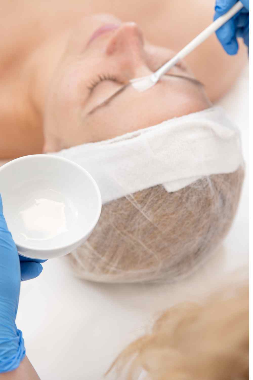 Where to get the best Chemical Skin Peel Treatment in Multan