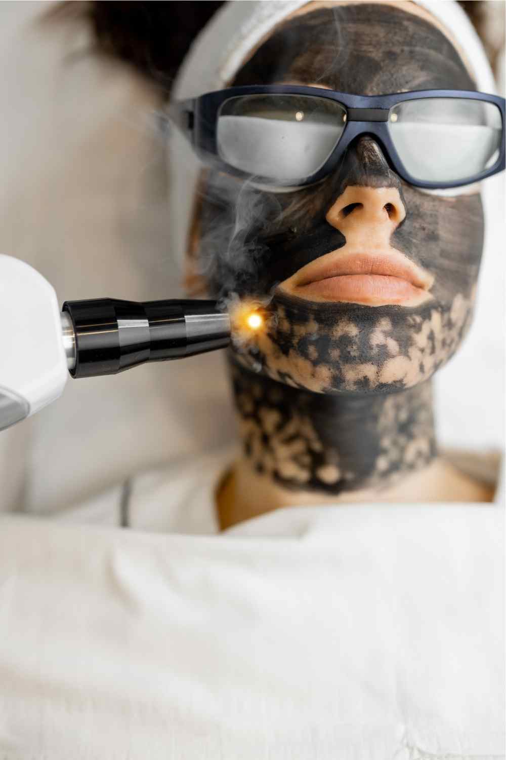 Why should you get carbon laser peel