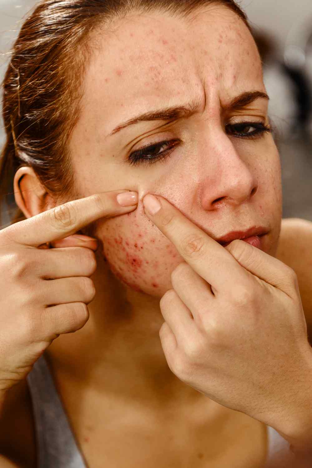 acne scars