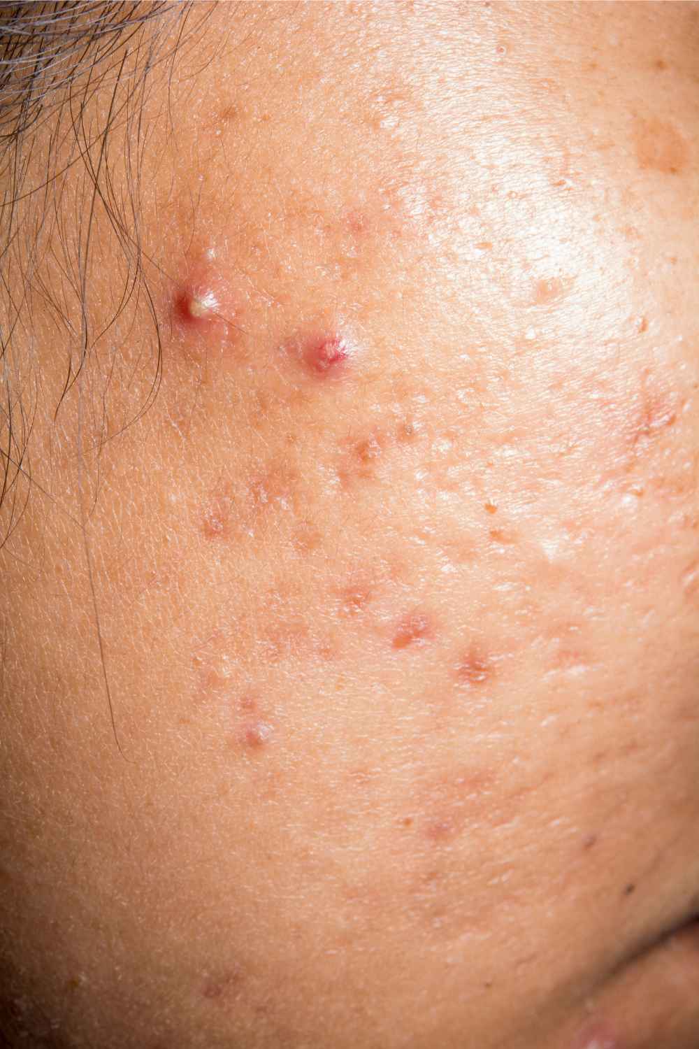 acne